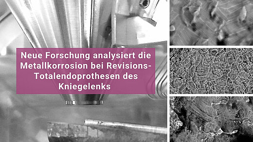 Bildkomposition mit Nahaufnahme mikroskopischer Ansichten von Korrosionsmustern, ergänzt durch Text zu neuer Forschung über Metalkorrosion bei Revisions-Totalendoprothesen des Kniegelenks.