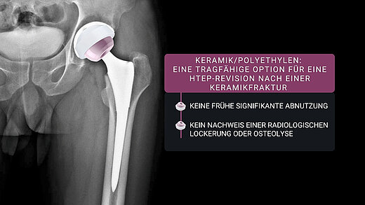 Röntgenaufnahme eines Hüftgelenks mit BIOLOX® delta-Keramik, ergänzt durch die wichtigsten Ergebnisse einer neuen klinischen und In-vitro-Studie zu CoP, durchgeführt von Dr. Jonathan Barrow und seinem Team.